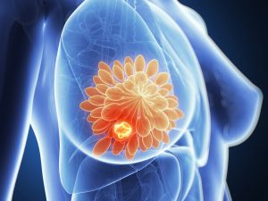 Cancer du sein suivi de tumeur pulmonaire et métastases cérébrales