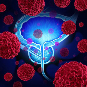 Cancer de la prostate : stabilisation par un traitement métabolique – report de la prostatectomie